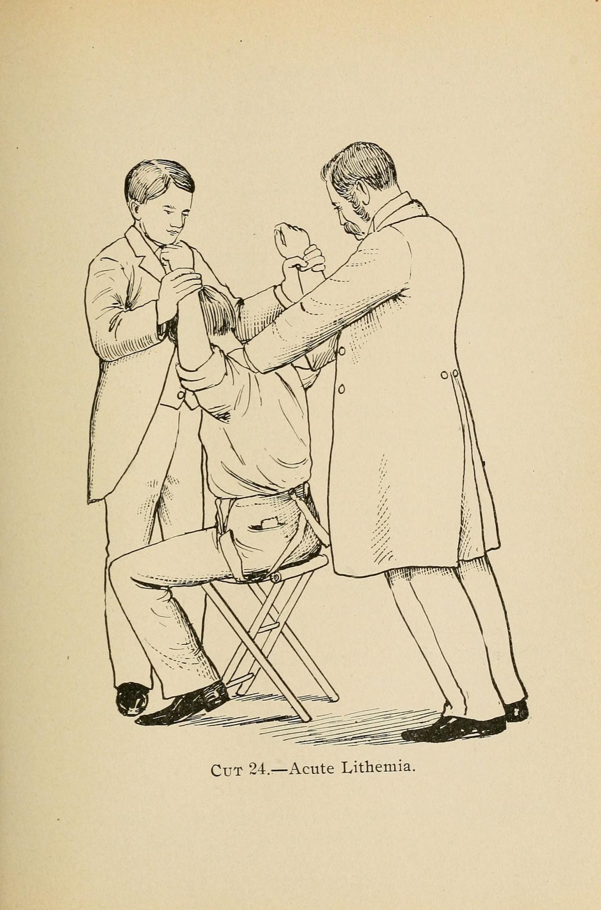 Gravure de 1898 : deux hommes en redingote tirent chacun sur un bras d’un patient assis sur un tabouret pliant. Légende : « Cut 24. Acute Lithemia ».