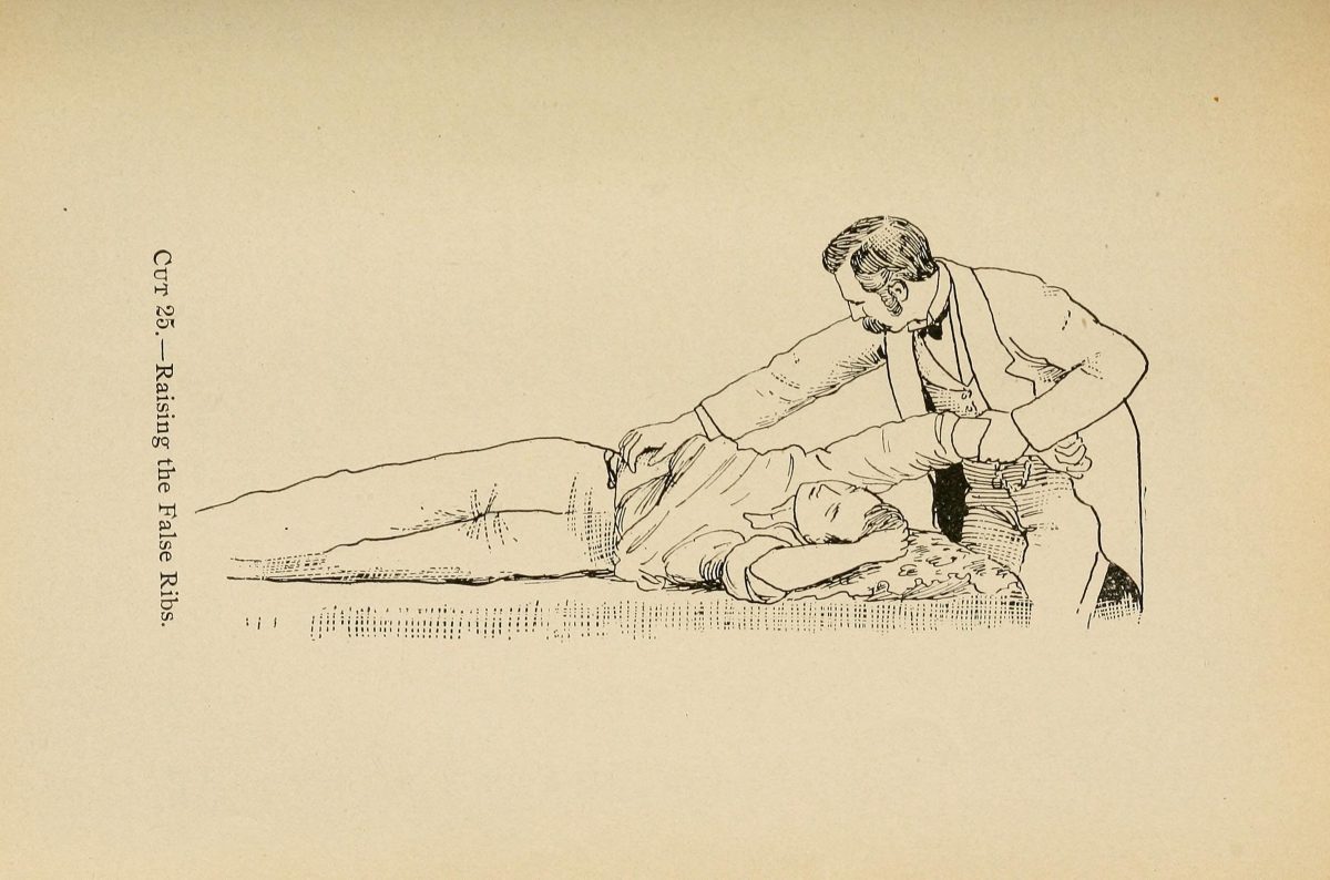 Gravure de 1898 : un homme penché sur un patient allongé sur le côté lui saisit le thorax à deux mains. Légende : « Cut 25. Raising the False Ribs ».